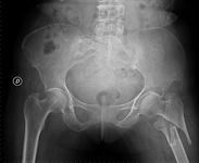 Kalça Kemiği Kırığı Belirtileri ve Tedavisi