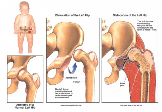 Bebeklerde Kalça Gelişim Geriliği