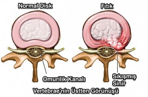 Bel Fıtığı Kalça Ağrısı Belirtileri ve Tedavisi