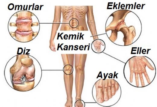 Kalça Kemiği Ağrısı Kanser Belirtileri ve Tedavisi