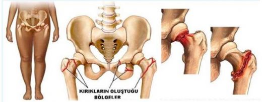 Kalça Kemiği Kırığı Ameliyatı Riskleri ve Sonrası
