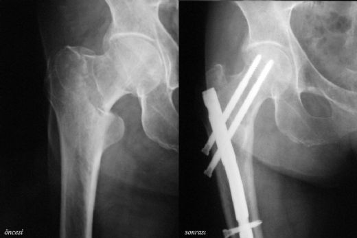 Kalça Kırığı Ameliyatı Sonrası ve Riskleri