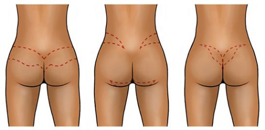 Kalça Küçültme Doğal Yöntemler