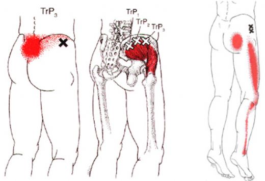 Kalça Tutulması Tedavisi