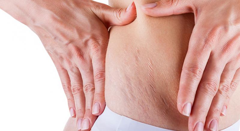 Kalça Çatlağı Belirtileri ve Tedavisi