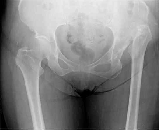 Kalça Displazisi Belirtileri ve Tedavisi