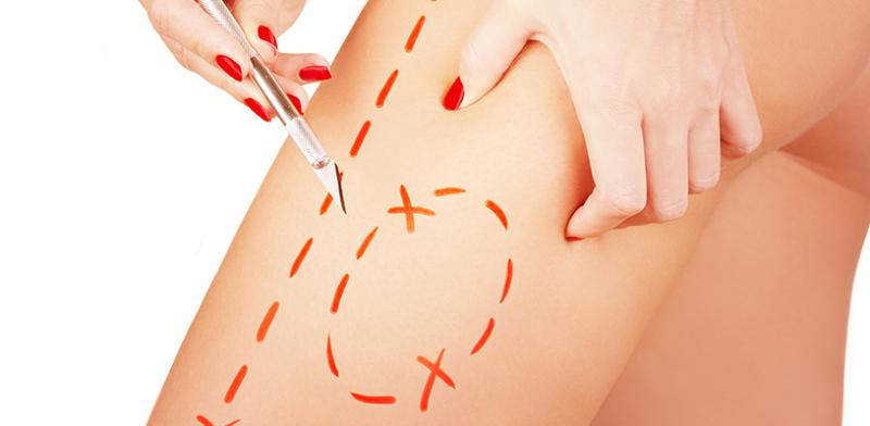 Kalça Estetiği Nedir ve Nasıl Yapılır?