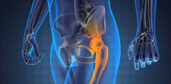 Kalça Kireçlenmesi Belirtileri ve Tedavisi