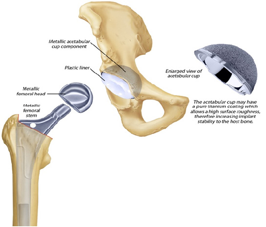 Kalça Protez Ameliyatı ve Komplikasyonları