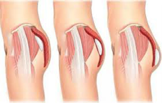 Kalça Silikonu Ameliyatı