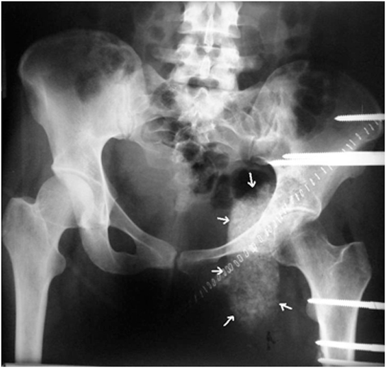 Kalçada Kist Belirtileri ve Tedavisi