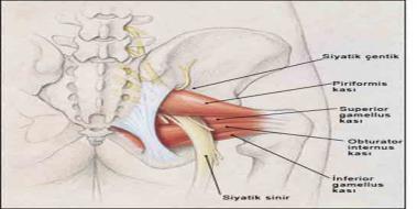 Kalçada Sinir Sıkışması