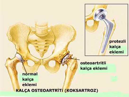 Total Kalça Protezi Ameliyatı